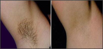 You want it to be clean and the blades to be sharp. Laser Hair Removal | Medical Day Spa of Chapel Hill | 919 ...