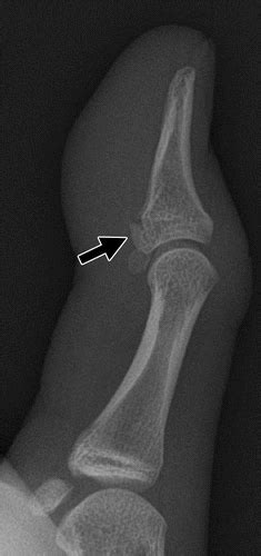 The flexor tendons of the hand play a very important role in functioning of the hand. Traumatic Finger Injuries: What the Orthopedic Surgeon ...