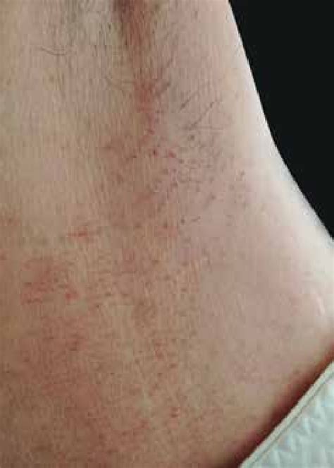 Armpit hair, also referred to as axillary hair, gets its start from puberty. Non-cicatricial alopecia on the axillary region | Download ...