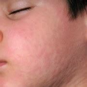 How to use opticrom drops Histamine Intolerance and Diet - The Relucant Raw Foodist