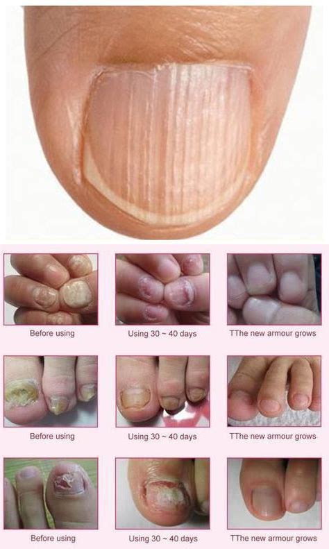 A beauty blogger has shared a graphic picture online of the damage caused by her acrylic nail addiction in a bid to warn other women. Nail treatment | Nail bed damage, Nail psoriasis, Yellow nails