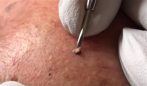 Pimple popping videos are so gross, yet somehow, they're also satisfying. youtube blackheads and large pores | New Pimple Popping Videos