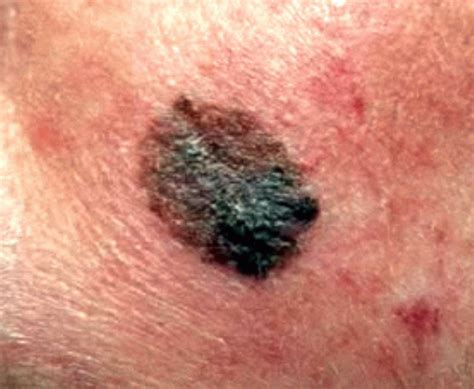 What does skin cancer look like? Pictures of skin cancer: Pictures of skin cancer