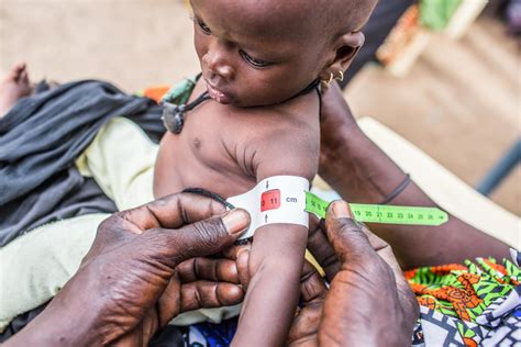Number of children suffering from severe acute malnutrition across the ...