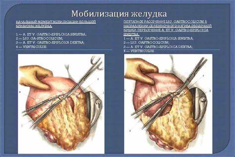 Диета послеоперационная при резекции желудка РЕЗЕКЦИЯ ЖЕЛУДКА Скелетотопия и проекция желудка на РЕЗЕКЦИЯ ЖЕЛУДКА Скелетотопия и проекция желудка на Диета послеоперационная при резекции желудка