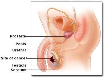 Those with light skin who sunburn easily have a higher risk. Testicular Cancer - Young Man's health