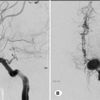 (PDF) Endovascular Treatment of Wide Necked Ruptured ...