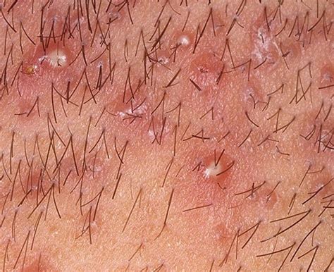 Ingrown hairs are hairs that curl back on themselves. Ingrown Vs. Folliculitis: Understand The Difference - Cool ...