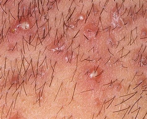 From ingrown hairs to stis, let's take a look at what could be causing white spots on your member. Ingrown Vs. Folliculitis: Understand The Difference - Cool ...