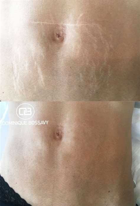 Scar cover up tattoo near me. Stretch mark camouflage near me > ALQURUMRESORT.COM