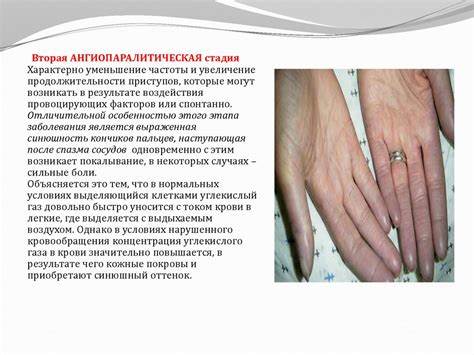 Рейно болезнь диета Болезнь Рейно - презентация онлайн Болезнь Рейно - презентация онлайн Рейно болезнь диета