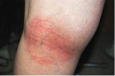 The resolution of submitted pictures should be approximately 2000x3500 at the minimum. Photograph of the posterior knee of case 1. The figure ...