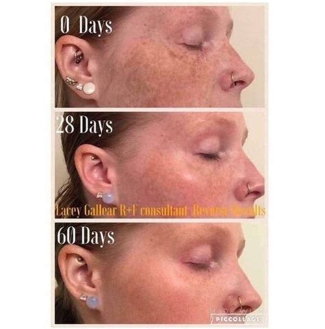 See full list on howtocure.com Do freckles ever go away? - Quora