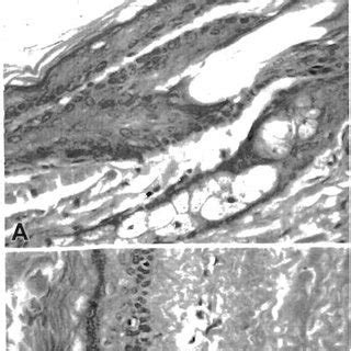 (PDF) The pathology of extracranial scalp and skull masses ...