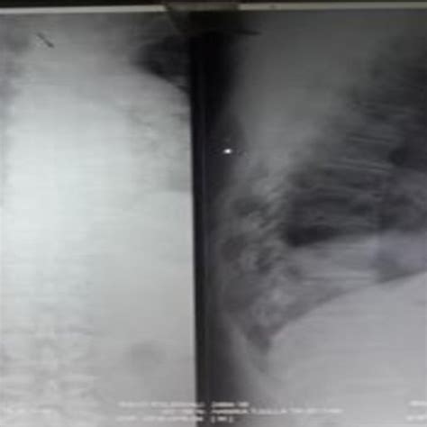 A single incision is made from the chest to the abdomen on the left side, and an incision is made in the neck. McKeown esophagectomy. Skin incision (red line) for right ...