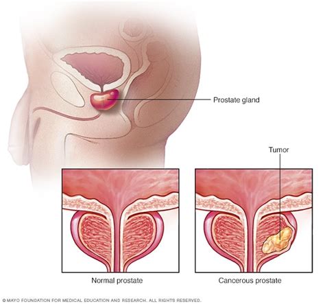 See full list on mayoclinic.org Prostate cancer - Symptoms and causes - Mayo Clinic