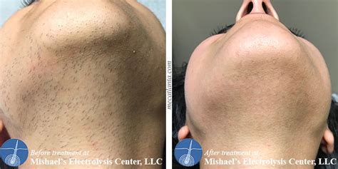 Electrolysis is a hair removal technique that involves inserting a needle into your skin. Before & After Electrolysis Hair Removal | Mishael's ...