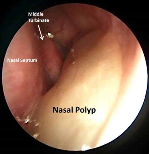 Nobody really knows what causes nasal polyps, or why they happen in some people, but don't happen in others. Nasal Polyps - Macrolide Response In Nasal Polyps Youtube ...