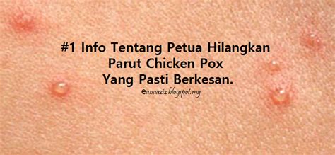 Kebiasaannya chicken pox ni akan terkene hanya sekali seumur hidup. Ubat Untuk Parut Chicken Pox - Perubatan c