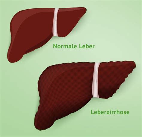 In der regel weist dunkler stuhlgang auf verletzungen oder erkrankungen im oberen verdauungstrakt hin. Leberzirrhose