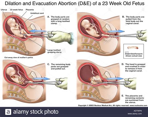 Check spelling or type a new query. Dilatation und Evakuierung Abtreibung D E eines 23 Wochen ...