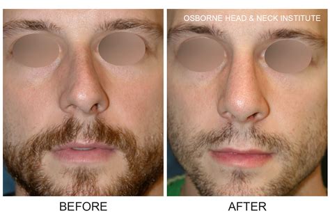 The septum is the cartilage in the nose that separates the nostrils. Before & After Rhinoplasty Photos - Rhinoplasty & Nose Surgery