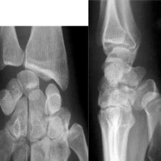 (PDF) Journal of Orthopedic Research and Therapy Case ...