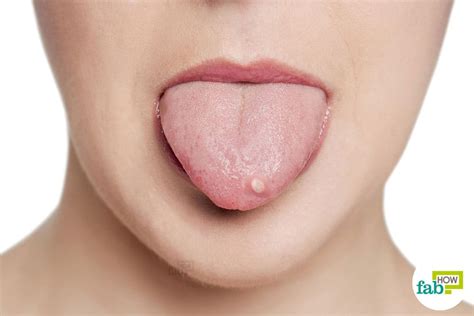 Do you suffer from black spots on tongue? How to Get Rid of Tongue Blisters: Disinfect and Heal the ...