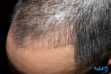 آمن على اللون الطبيعي للشعر. زراعة الشعر عن طريق الخلايا الجذعية - موقع فكرة