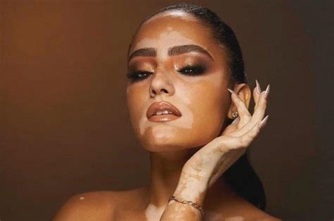 O nome dela é sara, sara sampaio. Modelo brasiliense com vitiligo inspira quebra de padrões ...