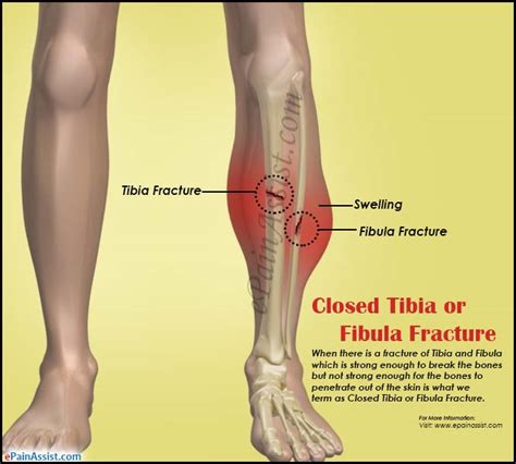 The fibula and the tibia join together at the knee and ankle joints. Closed Tibia or Fibula Fracture|Causes|Symptoms|Treatment ...