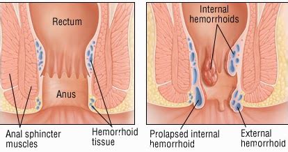 5.6k views reviewed >2 years ago. Hemorrhoids Doctor: What Are Internal hemorrhoids symptoms ...