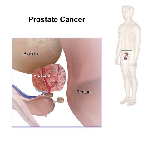 Prostate cancer rarely produces symptoms in the early stage; Wiki: Prostate cancer - upcScavenger
