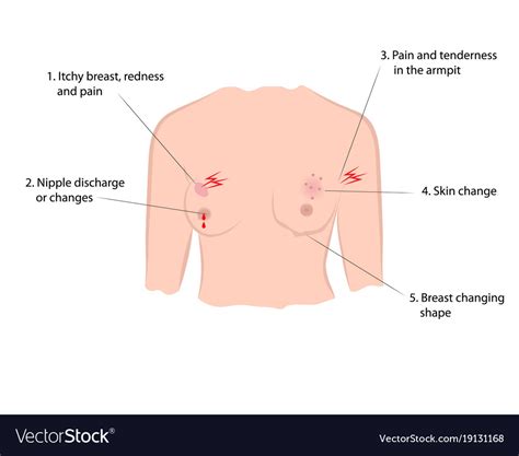 Symptoms hindi prostate cancer symptoms hindi bone cancer treatment hindi mammography test hindi symptoms of brain tumor females hindi gharelu upchar colorectal cancer hindi kya cancer thik hota hai breast cancer ka desi ilaj cancer video hindi what is symptoms of breast cancer. Early symptoms breast cancer Royalty Free Vector Image