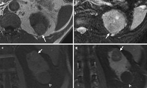 Renal disease is a relatively common complication in patients with human immunodeficiency virus (hiv) disease. Renal Parenchymal Neoplasms | Radiology Key