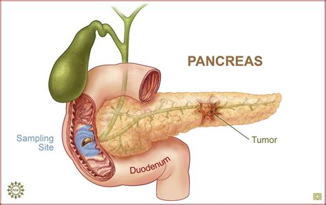 There remains a dire need for more research and an increase in focused. Early Detection of Pancreatic Cancer Using Light - TFOT