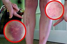 unexplained bruises body reason why appear