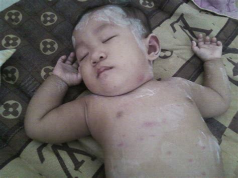 Untuk mengelakkan gatal pada badan pula, gunalah daun semambu dari pokok semambu dengan meletakkan daun itu dibawah cadar dan bantal sebagai alas tidur. EZI SWEET WORLD: Aimee kena Chicken Pox