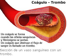 El concepto tradicional de enfermedad hemorroidal como «dilataciones venosas (várices)» ubicadas en el canal anal, ha sido muy difícil de cambiar a pesar del sinnúmero de estudios que ha demostrado lo errado de este concepto. DR Juan T. Alba: 1|04|11 2do Dia de clases de el 3er ...