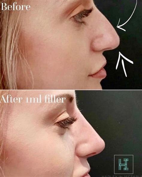 Kulbersh takes to perform the surgery. Non surgical nose job v rhinoplasty: Before after ...