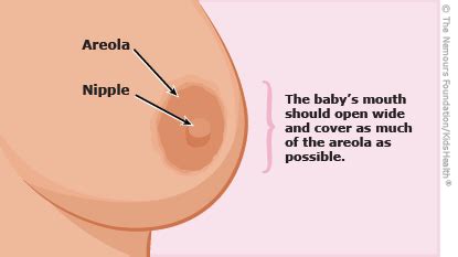 Lumps or nodes felt on or inside of the breast. Breastfeeding FAQs: Pain and Discomfort