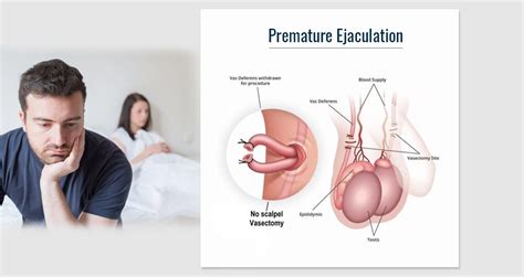 Looking for premature ejaculation treatment options? Global Premature Ejaculation Treatment Market Report ...