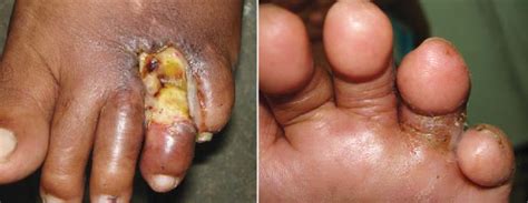 Don't put your leg at risk, get your leg healed immediately! Infected diabetic foot ulcer with (a) exposed joint and ...