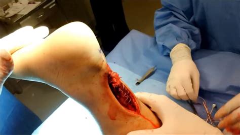 Mri of achilles tendon demonstrating normal achilles tendon body with abnormal insertion and island of calcified bone in the tendon (arrow). maxresdefault.jpg