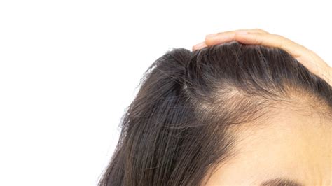 Hairstyles, such as box braids or tight ponytails, can pull on your locks and cause traction alopecia (9). Can Paragard Cause Thinning Hair | Makeuptutor.org
