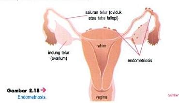 Setelah dokter mendiagnosis anda dengan kanker ovarium, mereka akan ingin menentukan bagaimana lanjutan kanker adalah. Anatomi dan Fisiologi System Genetalia Feminina "Kelompok ...