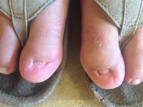 Many times the first symptom of a subungual melanoma is a dark line that appears underneath your nail. Big toe nails will never grow back. : WTF