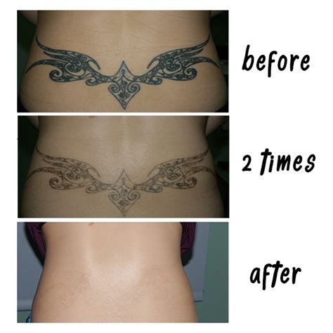 We treated this large lower back flower tattoo with five laser tattoo removal sessions. Result of Laser Tattoo Removal Before and After | Must See