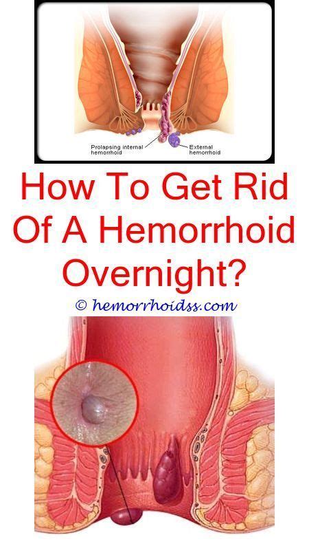 They are classified as grade iv hemorrhoids. Few folks recognize exactly how to efficiently deal with ...