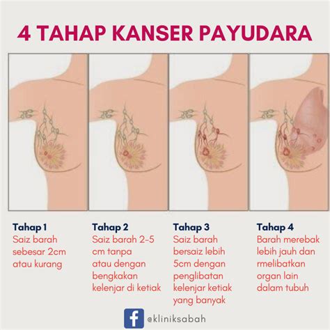 Leukemia atau kanser darah lain boleh bermula dengan gejala demam yang tidak sembuh. 4 tahap kanser yang anda perlu tahu - Klinik Sabah